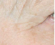 Unveiling the Benefits of PRP Therapy for wrinkles and Aging Skin